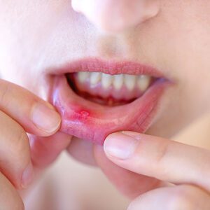 canker sore 2025 543 1 Blue Stone Hills Dentistry